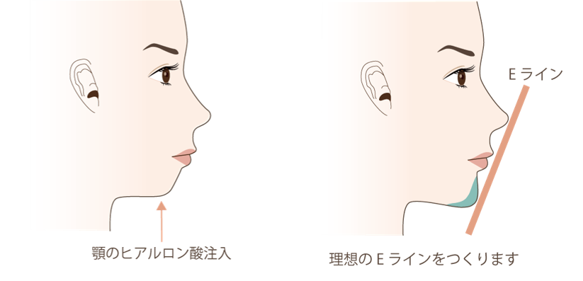 顎のヒアルロン酸注入の美容整形について 大阪院 梅田 美容整形なら水の森美容外科 公式