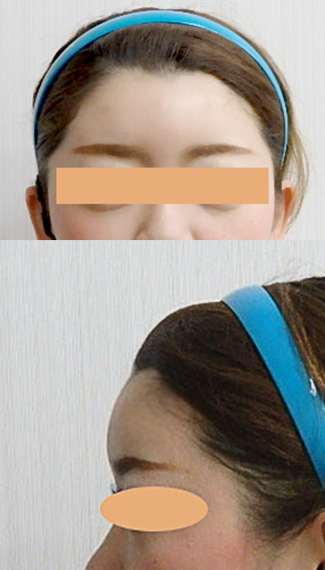 額のヒアルロン酸注射の症例写真2術後