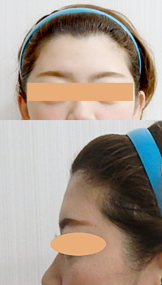 額のヒアルロン酸注射の症例写真2術前