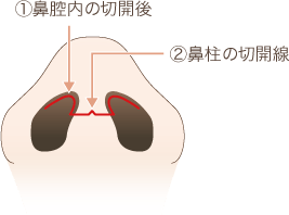 鼻中隔延長の手術方法