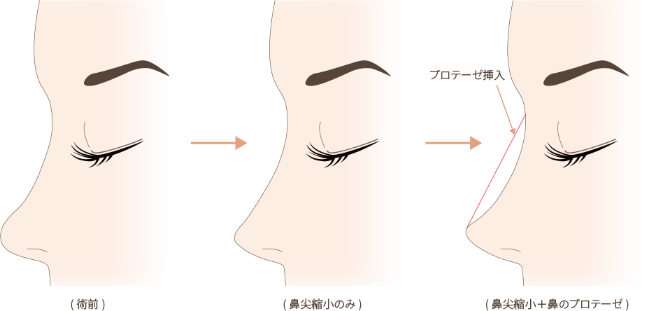 鼻尖縮小の美容整形について 大阪院 梅田 美容整形 美容外科なら水の森美容外科 公式