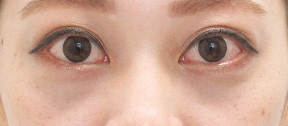 下眼瞼脱脂の症例写真(術後1ヶ月)