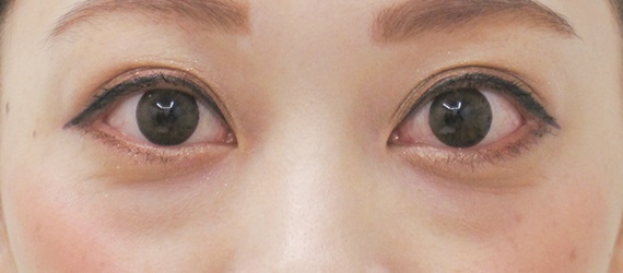 下眼瞼脱脂の症例写真(術前)