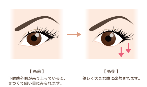 下眼瞼下制術 たれ目形成 の美容整形について 大阪院 梅田 美容整形 美容外科なら水の森美容外科 公式