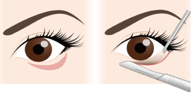 下眼瞼下制術 たれ目形成 の美容整形について 大阪院 梅田 美容整形 美容外科なら水の森美容外科 公式