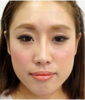 鼻プロテーゼの美容整形について 大阪院 梅田 美容整形 美容外科なら水の森美容外科 公式