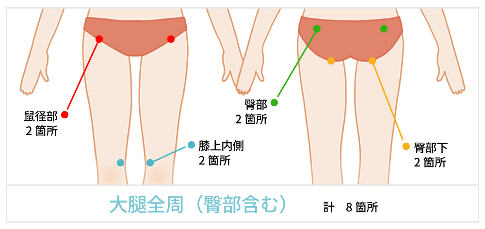 脂肪吸引で傷が出来る箇所の説明 お尻