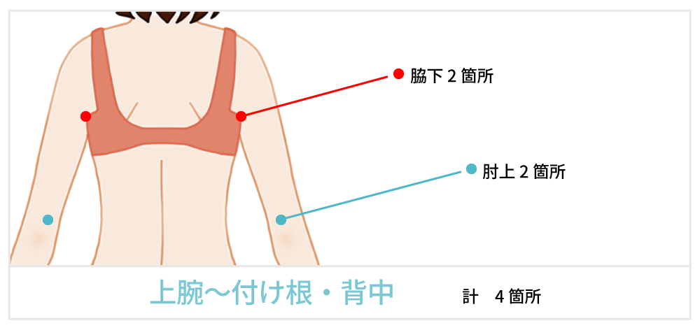 脂肪吸引で傷が出来る箇所の説明 背中