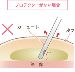 脂肪吸引 顔 太腿 お尻 二の腕 お腹 ウエスト の美容整形について 大阪院 梅田 美容整形 美容外科なら水の森美容外科 公式