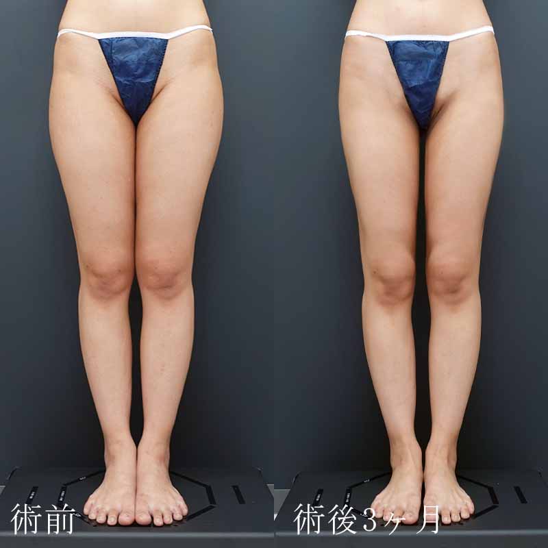大阪の太もも・お尻の脂肪吸引なら水の森美容クリニック梅田・心斎橋院