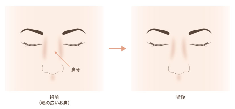 鼻骨骨切りの美容整形について 大阪院 梅田 美容整形 美容外科なら水の森美容外科 公式