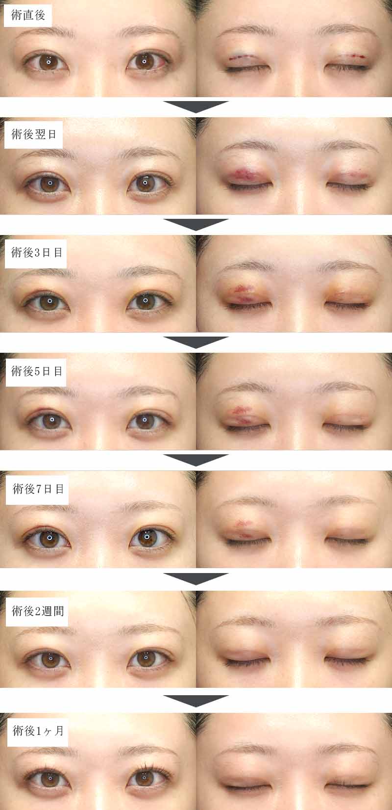 自然癒着法の術後経過(術直後〜術後1ヶ月のお目元)