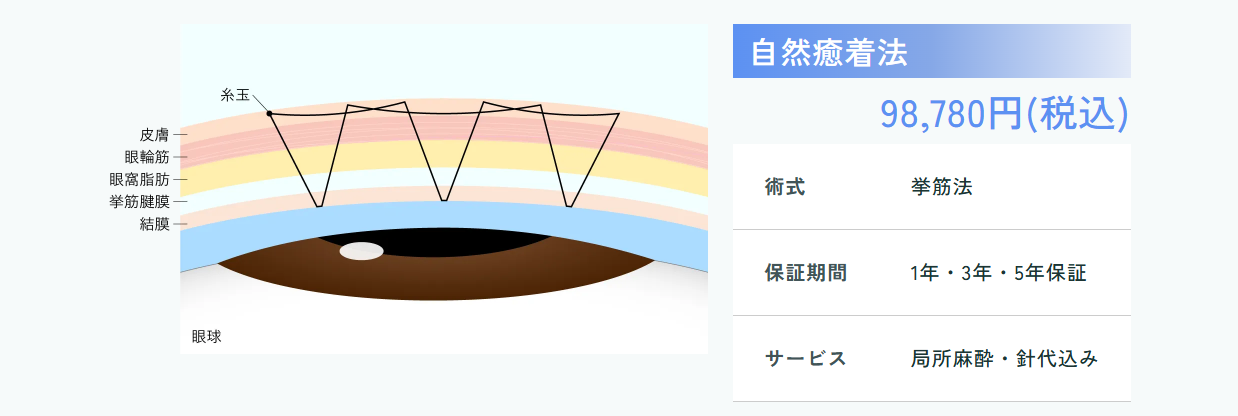 自然癒着法 98,780円(税込)/術式:挙筋法/保証期間:1年・3年・5年保証/サービス:局所麻酔・針代込み