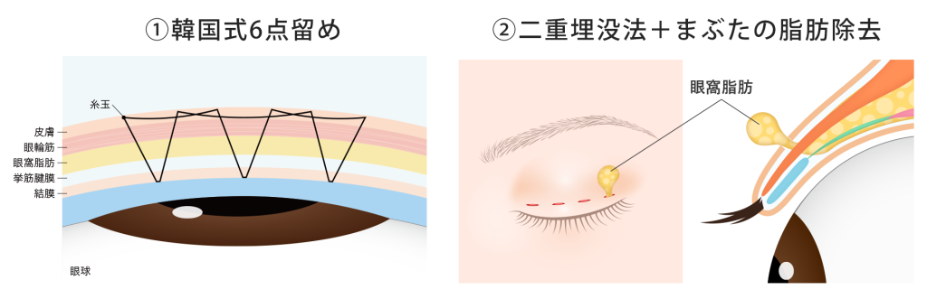 自然癒着法の種類(韓国式6点留め/二重埋没法+まぶたの脂肪除去)