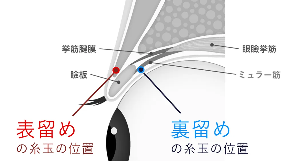 表留めと裏留めの糸玉の位置